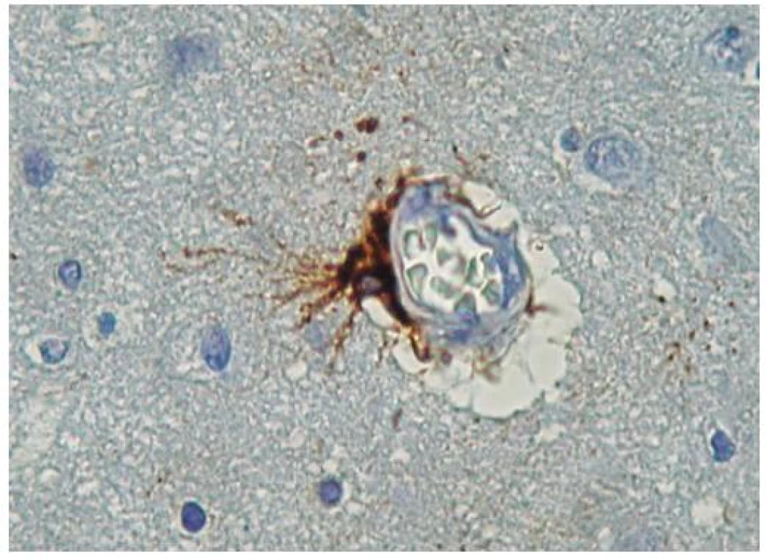 GFAP imunopozitivita v protoplasmatické astroglii s dobře patrnými perivaskulárními výběžky tvořící součást hematoencefalické bariéry mozku. V lumen cévy erytrocyty. Zvětšení 1000x.