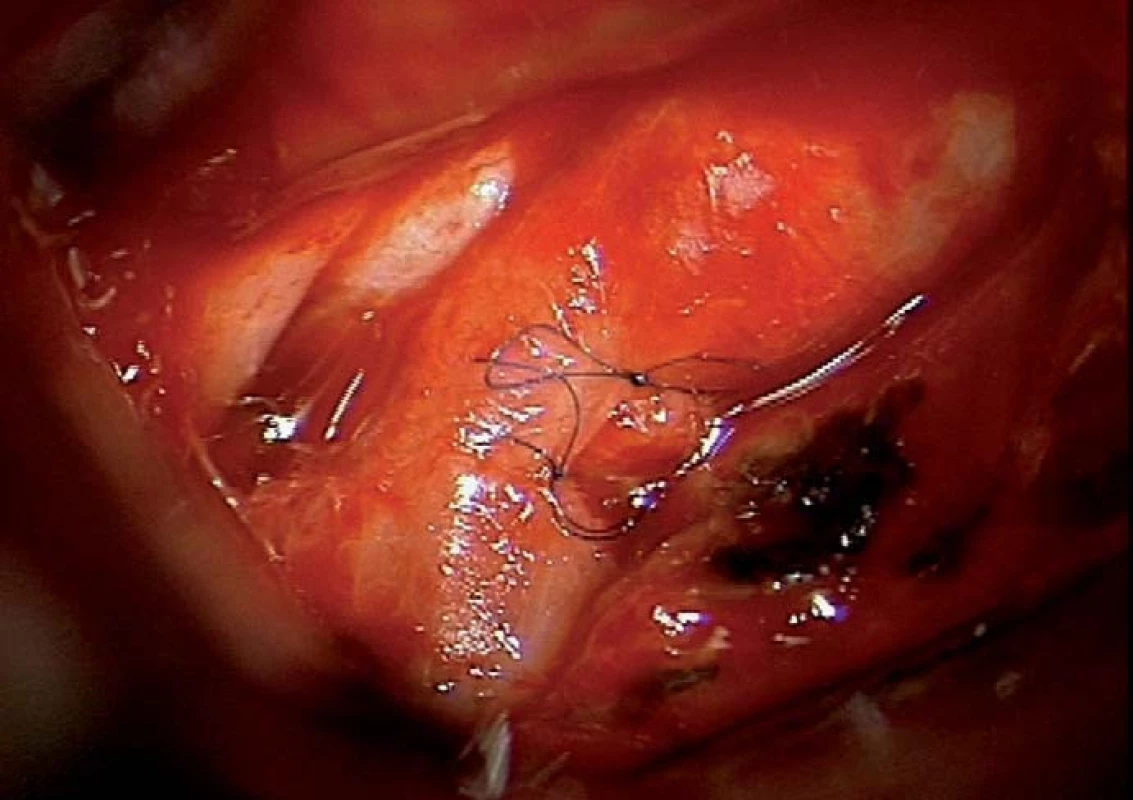Sutura defektu krkavice po reruptuře aneuryzmatu.