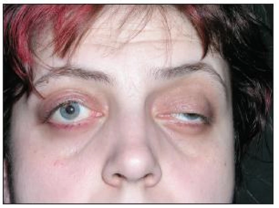 Foto obou očí před provedením tarzorafie – na pravém oku po operaci ptózy, na levém oku ptóza horního víčka