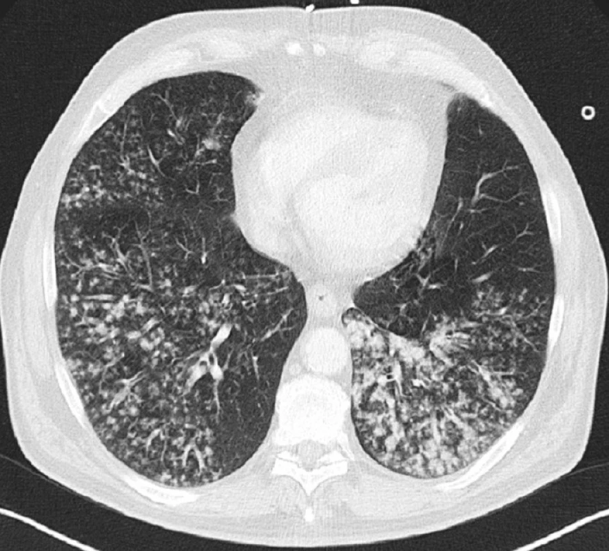 CT scan bazální oblasti plic s drobnoložiskovým procesem, 1. den
Fig. 1. CT scan of the pulmonary base with multiple small opacities detected, Day 1