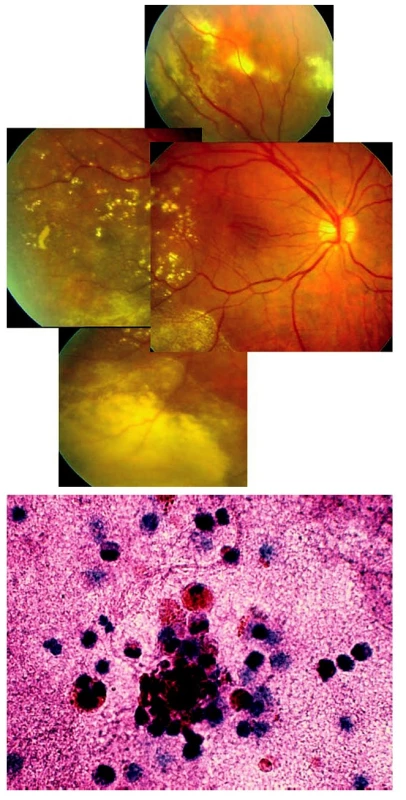 Coatsova nemoc manifestující se jako zadní uveitida nejasné etiologie u 55leté ženy. A) Patrné žluté transudáty, nařasení sítnice v makule a cévy nepravidelného kalibru v periferii očního pozadí pravého oka. B) Cytologické vyšetření sklivce prokázalo směs erytrocytů s drobnými kulatojadernými buňkami původu gliového, eventuálně lymfocytárního. Nález odpovídá nezánětlivému očnímu onemocnění
