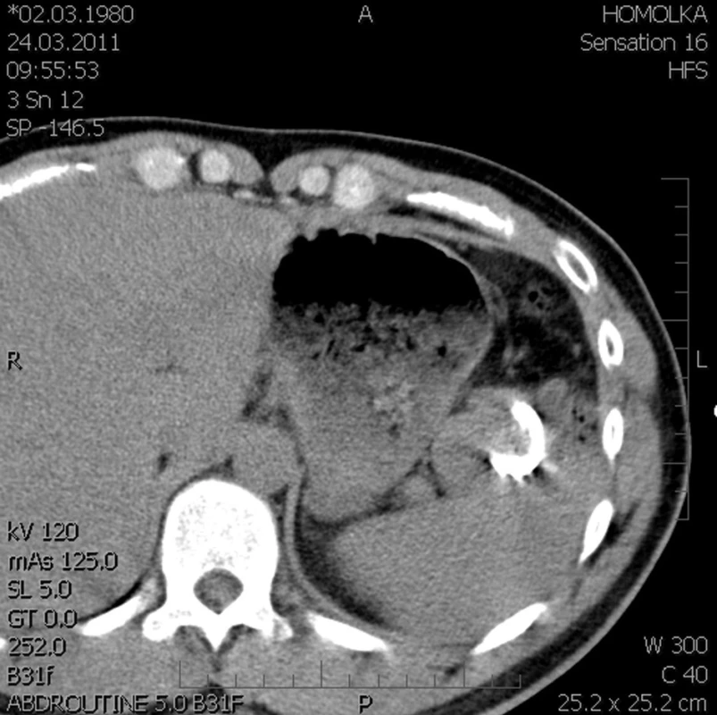 Evakuovaná cysta na CT (kazuistika 2)
Fig. 8: Evacuated cyst on CT (case 2)