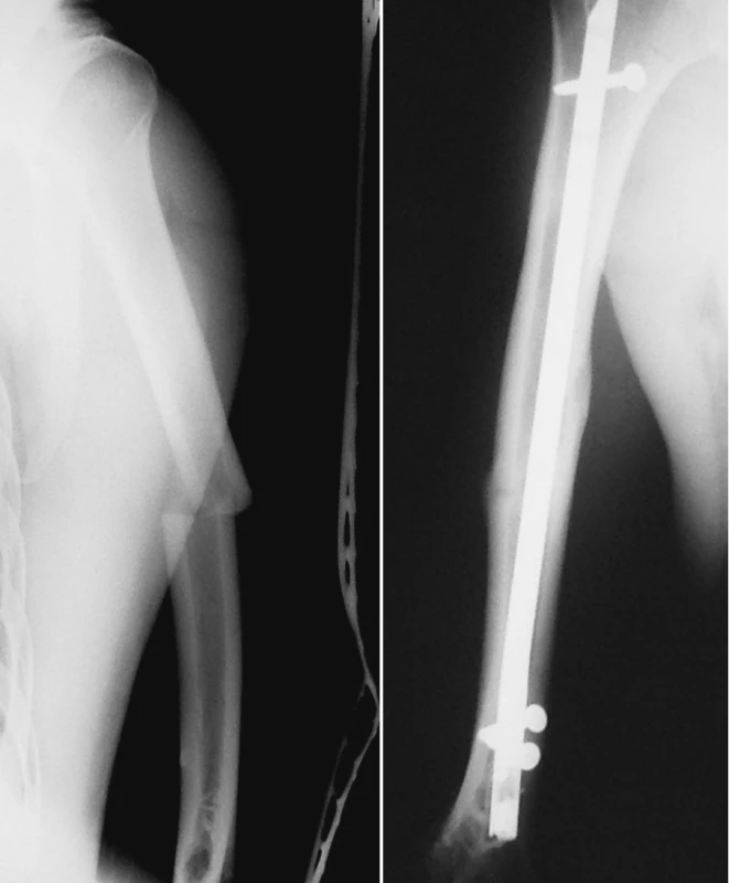 a. RTG obraz zlomeniny diafýzy pažní kosti
Pic. 2a. X-ray picture of the humeral shaft fracture
b. RTG obraz zhojené zlomeniny pažní kosti po nitrodřeňové osteosyntéze retrográdně zavedeným zajištěným hřebem UHN
Pic. 2b. X-ray picture of the healed humeral shaft fracture after intramedullar osteosynthesis by retrograde unreamed humeral nail
