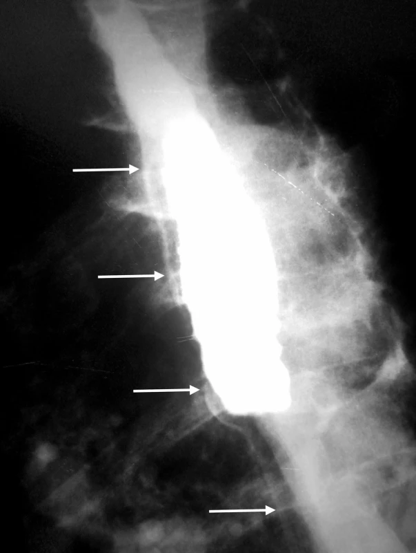 Extraluminálny únik kontrastnej látky?
Tenký prúžok kontrastu v skutočnosti vyznačuje priebeh falošného lúmenu (biele šipky). Rádiolucentný pás medzi pravým a falošným lúmenom vytvára tzv. príznak slizničného pruhu (mucosal strip sign)
Fig. 2: An extraluminal leak during the esophagography?
In fact, this is a „mucosal strip“ sign that is indicative of the intramural dissection with the presence of the false lumen (white solid arrows)