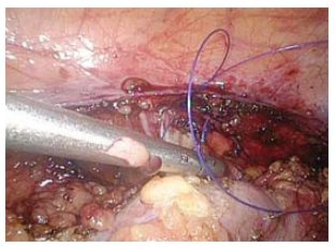 Jehla zapíchnutá v pravé ledvině
Fig. 4. Needle digged in the right kidney