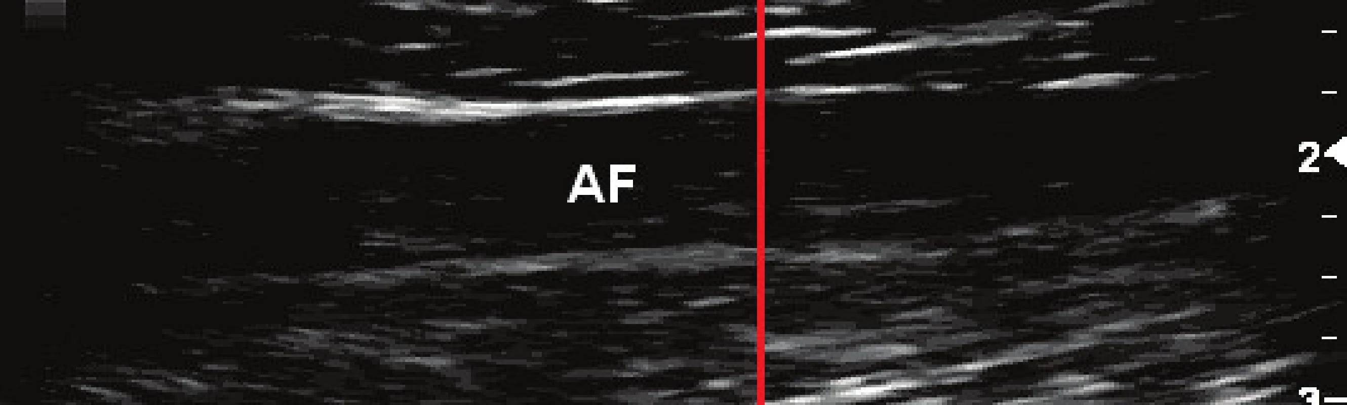 Upravený vstupní snímek stehenní tepny (AF) s vyznačeným směrem pro zisk jasového profilu vedeným kolmo na cévní stěnu (sloupec W = 300 px obrazu).