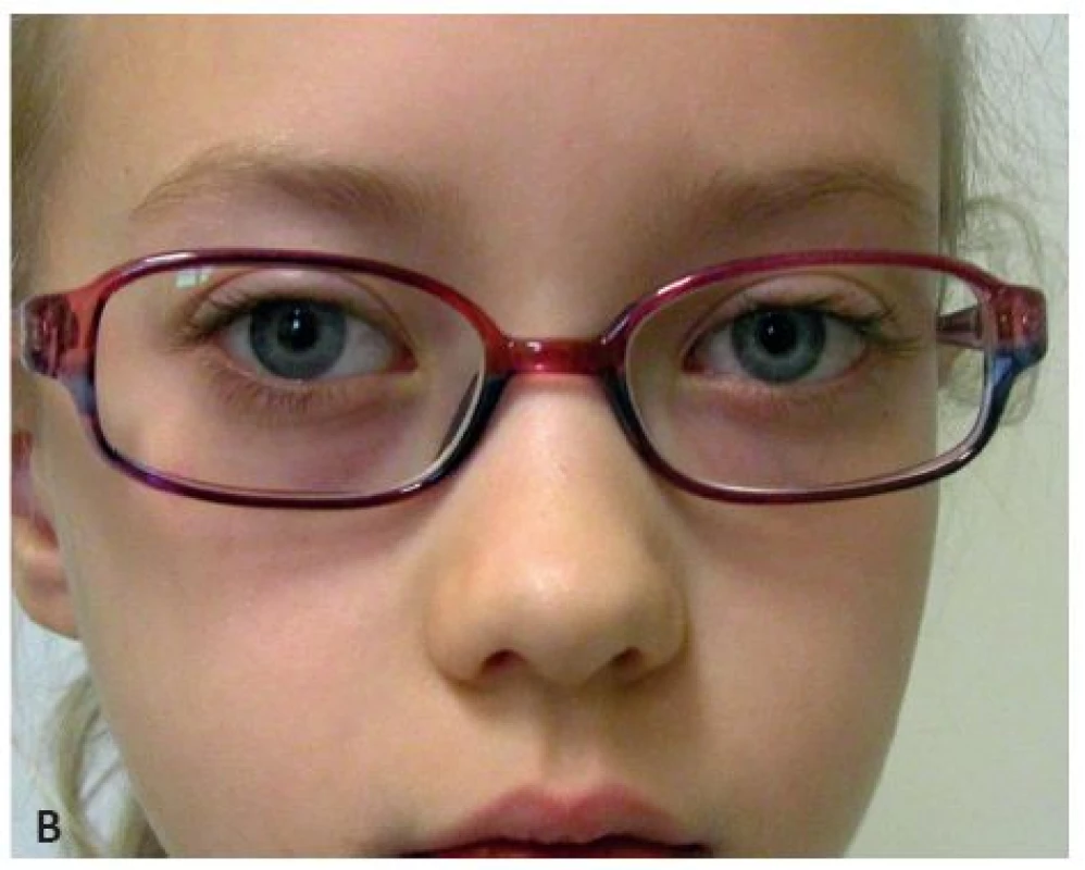 Osmiletá pacientka s inciální formou strabismus sursoabduktorus – A: postavení bulbů před operací a B: postavení bulbů po operaci