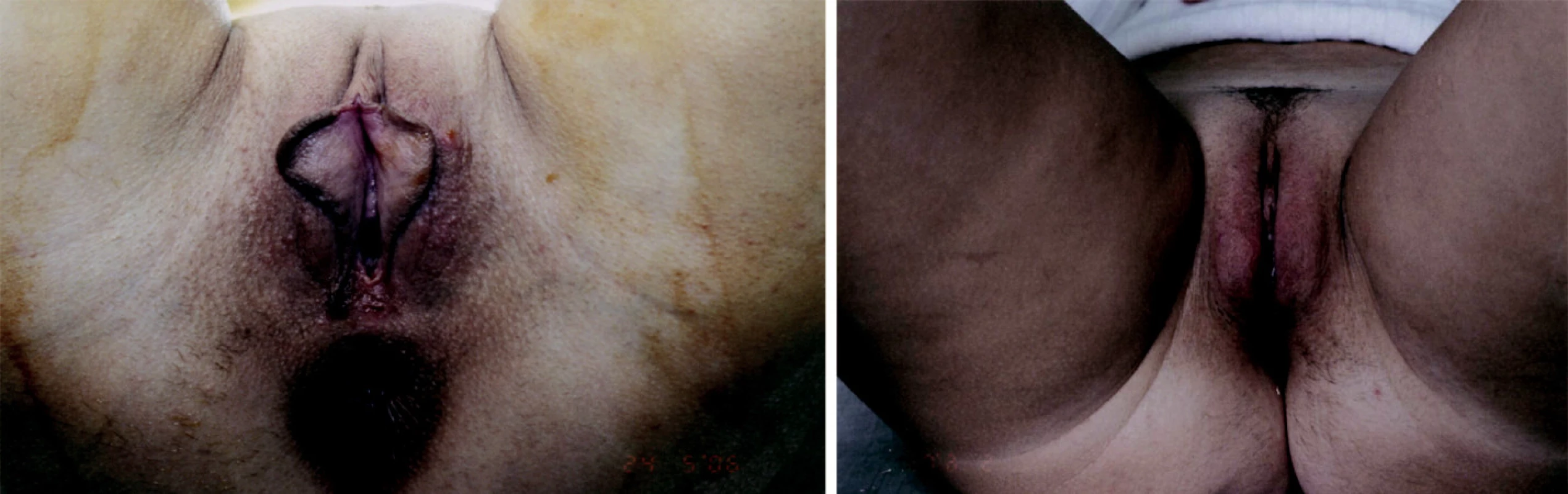 Stav před a po redukci malých stydkých pysků a zvětšení velkých stydkých pysků (foto z archivu J. Války).