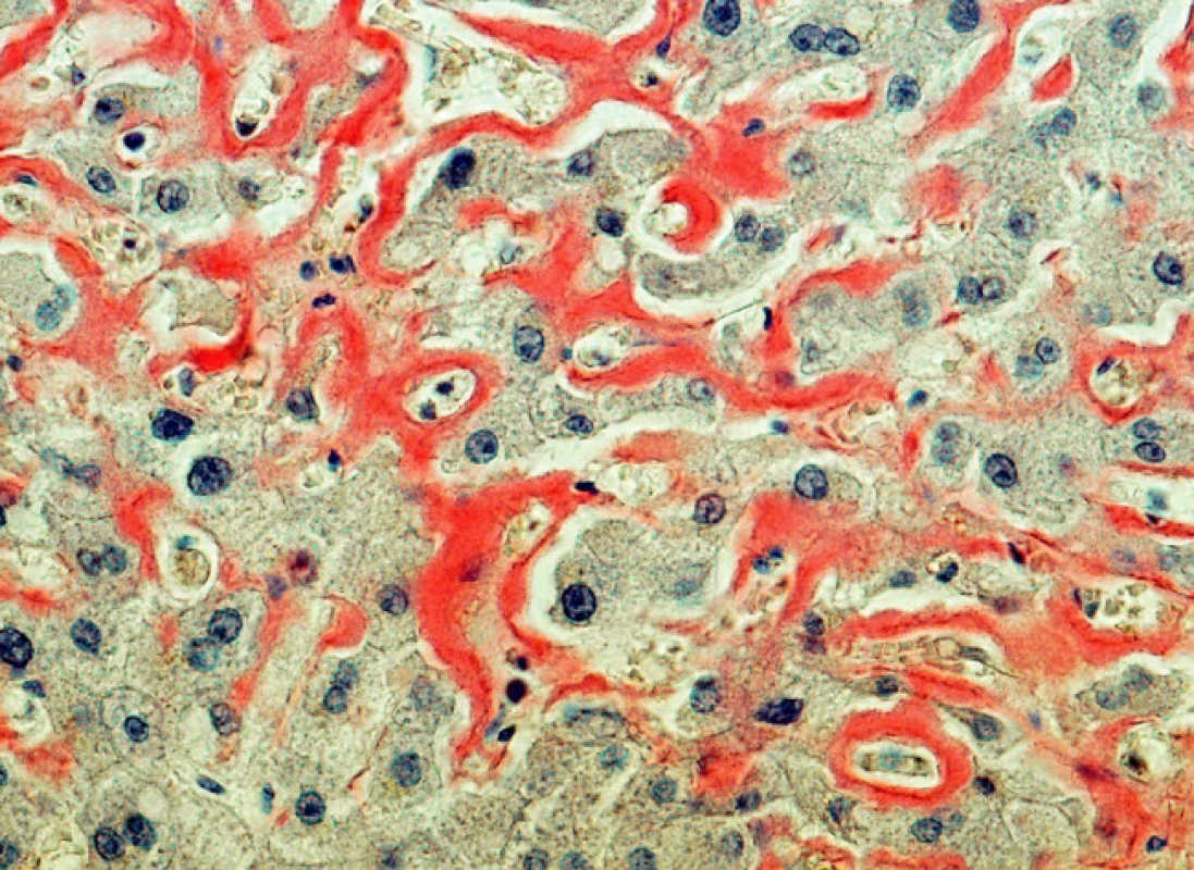 Depozita amyloidu v játrech (barvení Kongo červení, objektiv 20krát)