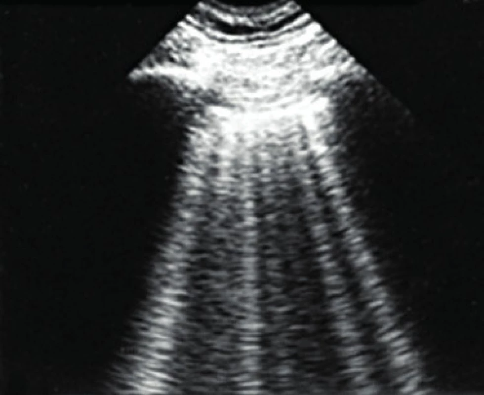 Plicní ultrazvuk u pacienta s plicním edémem s patrnými B3 vertikálními liniemi