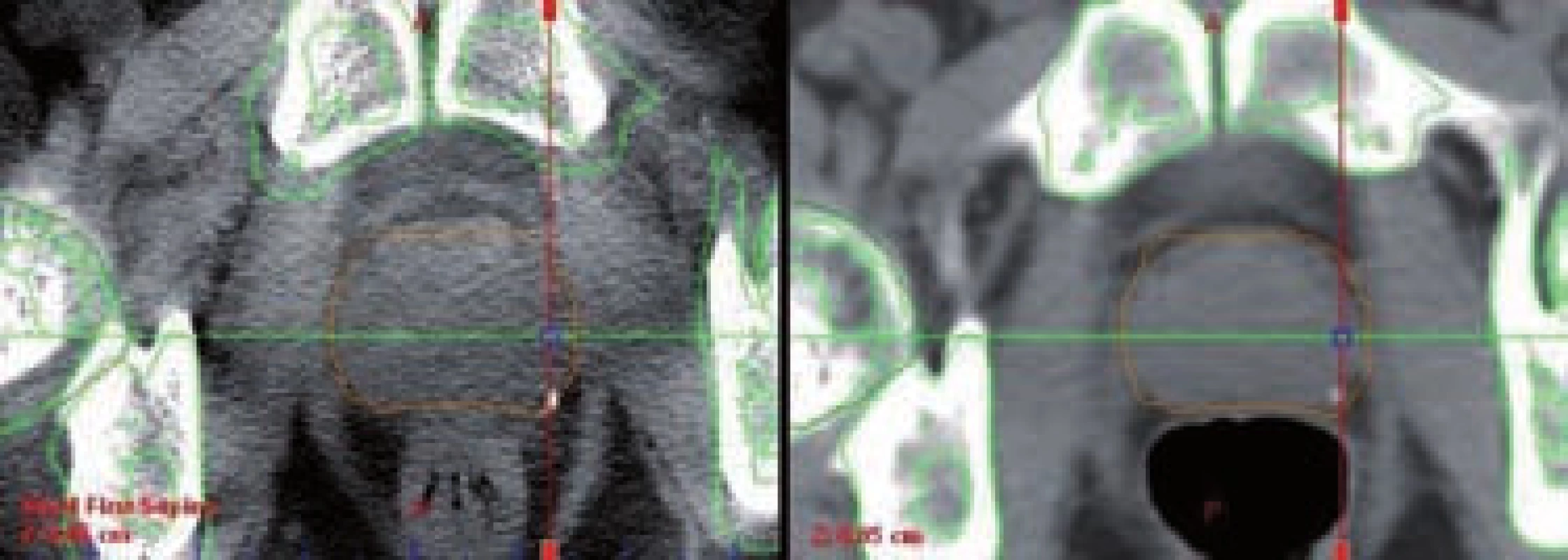 kV cone-beam CT (CBCT) – radioterapie řízená obrazem (IGRT) 
Fig. 10 kV cone-beam CT (CBCT) – image-guided radiation therapy (IGRT)
