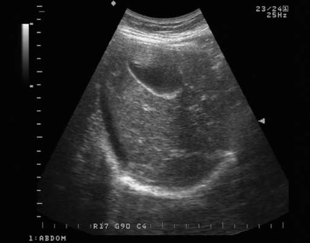 Sonografický obraz ascitu v okolí jater.
Fig. 1. Ascites close to liver in abdominal ultrasonography.