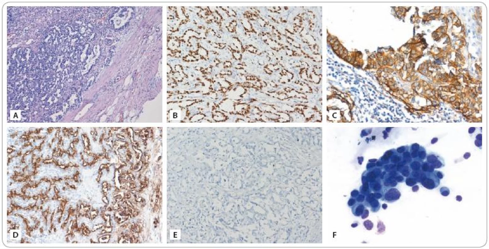 A) Infiltrace lymfatické uzliny metastázou adenokarcinomu plicního origa odpovídající nemucinóznímu bronchioloalveolárnímu karcinomu (dle podrobného imunoprofilu – viz text). Barvení hematoxylin – eozin. Zvětšeno 100×. B) Imunohistochemické vyšetření exprese TTF-1 (thyroid transcription factor-1, specifi cký marker pro adenokarcinomy plicního origa): pozitivní průkaz. Zvětšeno 200×. C) Imunohistochemické vyšetření exprese EGFR: pozitivní průkaz silné membránové exprese. Zvětšeno 200×. D) Imunohistochemické vyšetření exprese antigenu CA 15-3: pozitivní průkaz. Zvětšeno 200×. U pacienta byl antigen CA 15-3 ve zvýšené koncentraci detekován rovněž v séru. E) Imunohistochemické vyšetření exprese antigenu CA 125: negativní průkaz. U pacienta byl antigen CA 125 ve zvýšené koncentraci detekován v séru. Nejspíše však pocházel z buněk mezotelu pleury, neboť nádorové buňky tento antigen neexprimovaly. F) Trs nádorových buněk získaných z cytospinu aspirátu bronchoalveolární laváže provedené v době progrese nemoci. Vyšetřením byla prokázána maligní bronchorrhea. Barvení MGG, zvětšeno 630×. (Fotografie a vyšetření provedli: MUDr. Pavel Fabian, Ph.D., MUDr. Eva Krejčí).