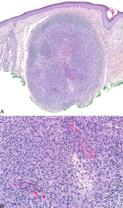 Sebaceózní karcinom, který je z velké části nekroticky změněn (A); maligní cytologické detaily zahrnují nukleární pleomorfismus a četné atypické mitózy (B)
