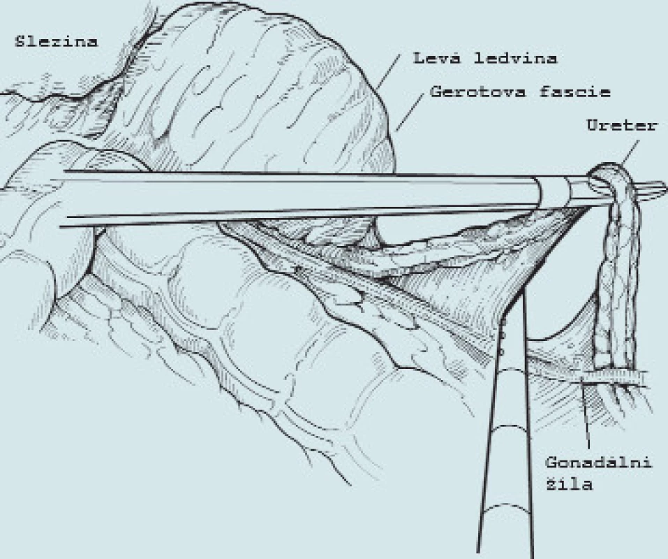 Po otevření peritonea a Gerotovy fascie se vypreparuje ureter a přeruší, gonadální žíla lze většinou odsunout mediálně bez nutnosti přerušení.