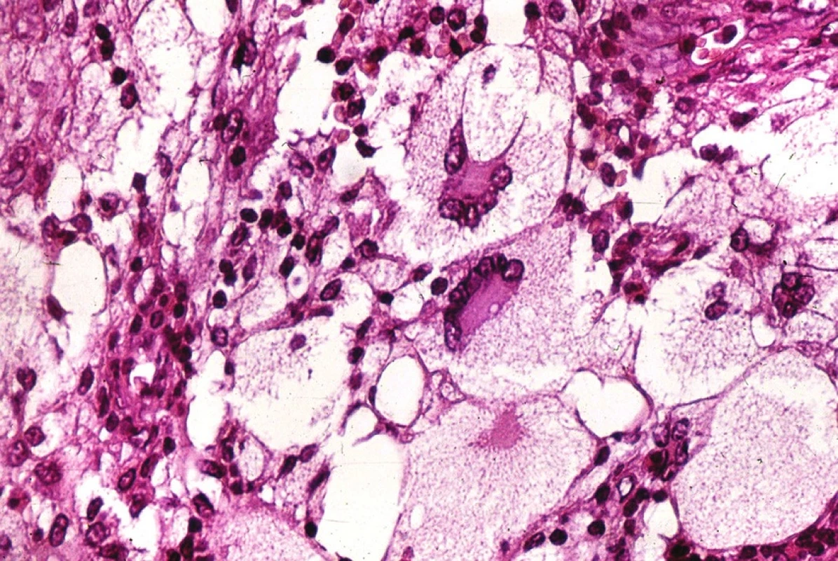 Obrovské vícejaderné buňky u Hand-Schüller-Christianovy choroby jen vzdáleně připomínají obrovské vícejaderné elementy běžných obrovskobuněčných lézí kostí. HE, x400.