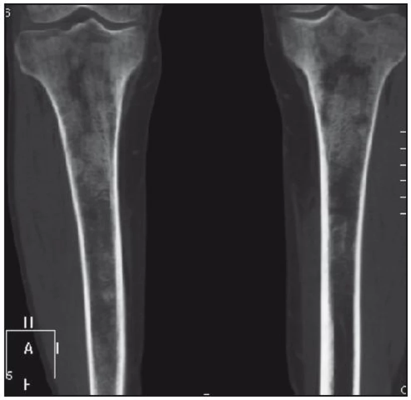 Zobrazení tibie izotropní metodou multidetektorového CT, koronární rovina. Zřetelná osteoporotická struktura s osteosklerotickými ložisky.