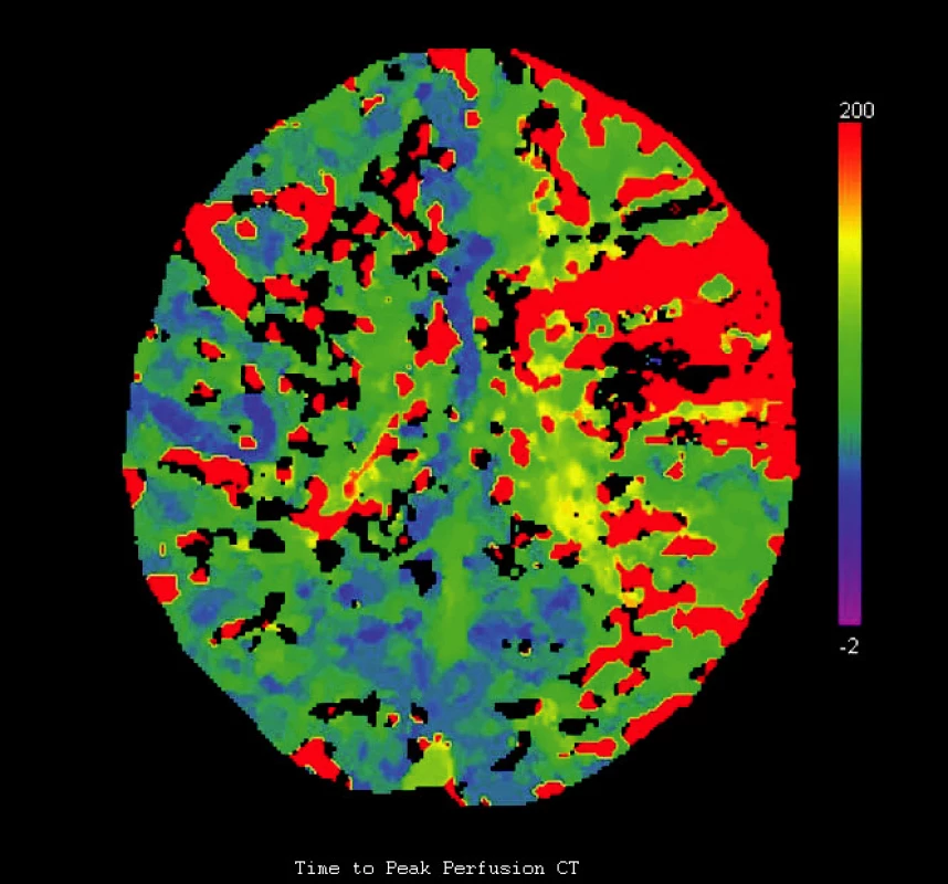 Perfuzní CT (time to peak) prokazuje výpad perfuze vlevo (infarktové ložisko) a hypoperfuzi v celém povodí levé ACI (oligemie a penumbra) (stranově převrácené zobrazení)
