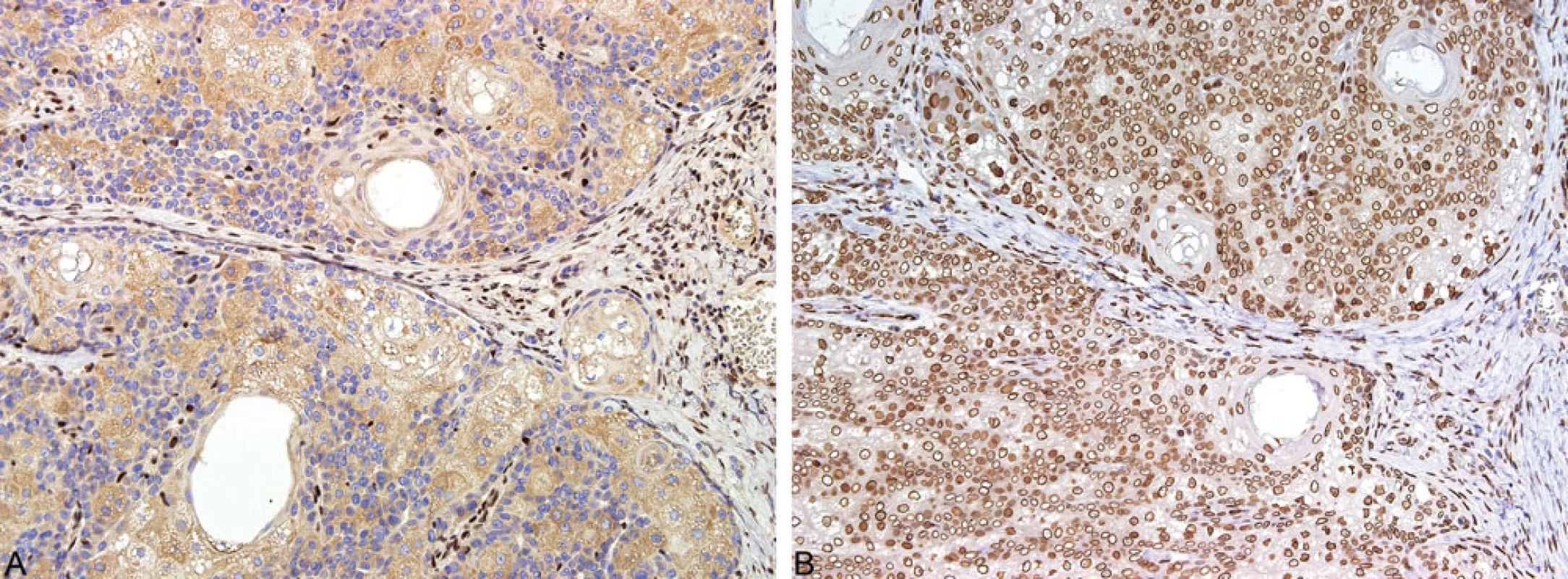 Imunohistochemické vyšetření exprese MMR proteinů: ztráta exprese MSH2 v nádorových buňkách s pozitivní interní kontrolou, tj. lymfocyty (A); exprese MLH1 proteinu nádorovými buňkami (B)