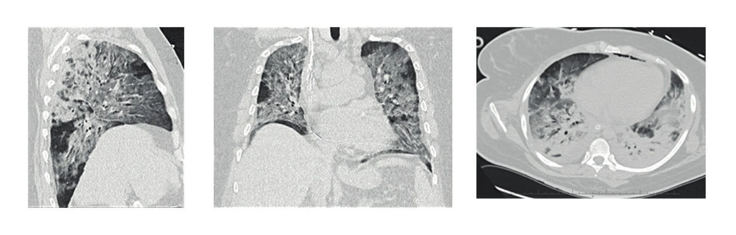 HRCT plic s nálezem ARDS (difuzní nehomogenní zastření plicního parenchymu), těžké bilaterální postižení při H1N1 intersticiální pneumonii
