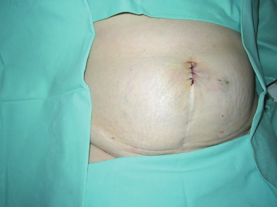 Operačná rana po SILS porte v jazve po dolnej laparotómii
Fig. 4. SILS port wound in low middle laparotomy scar