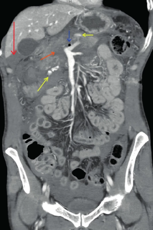 CT nález svědčící pro komplexní poranění hlavy pankreatu a duodena
Fig. 1. CT finding showing complex pancreatic head and duodenum injury