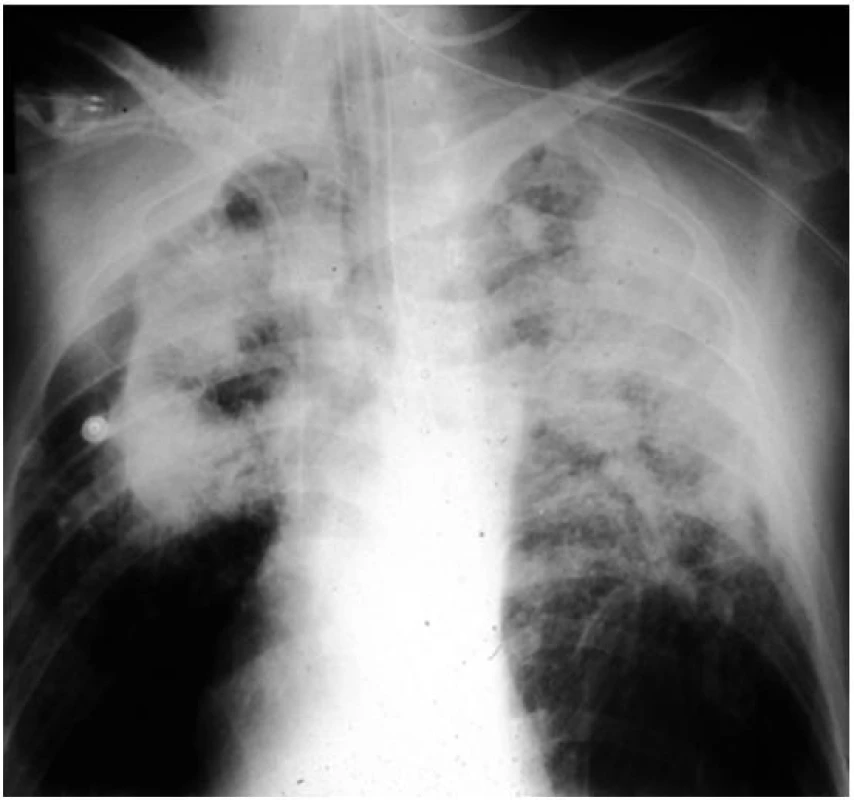 Komplikovaná silikóza plic
Ve středních a horních segmentech plic jsou jasně patrné splývající opacity o velikosti nad 10 mm.