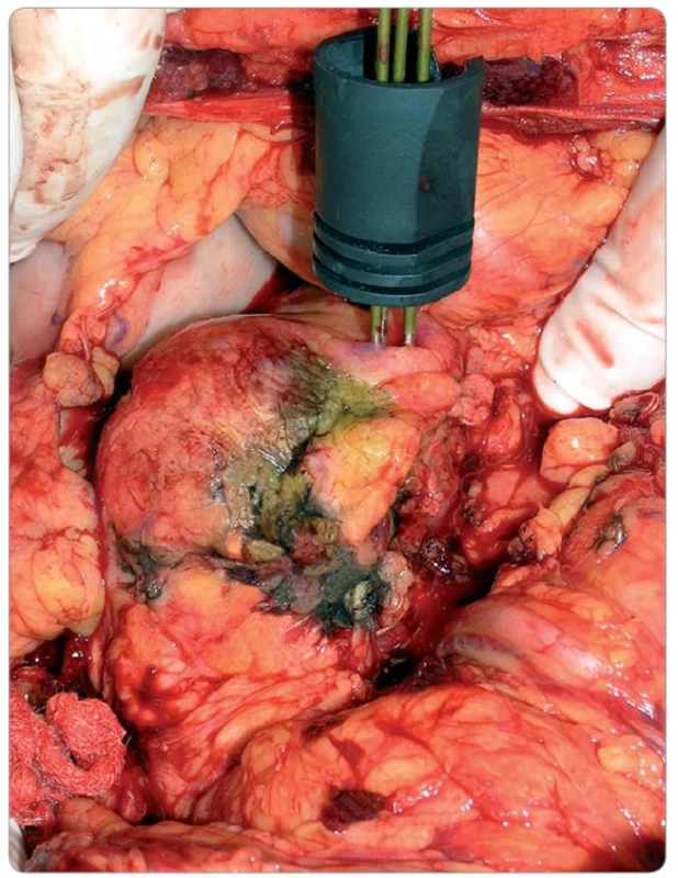 Předoperační fotografi e zobrazující neuroendokrinní tumor hlavy pankreatu se dou (obr. 1). Nádor byl ablován ze čtyř zavedenou cluster elektrodou.