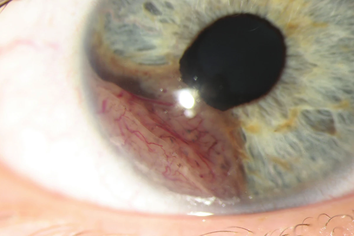 Melanom duhovky pravého oka před operací