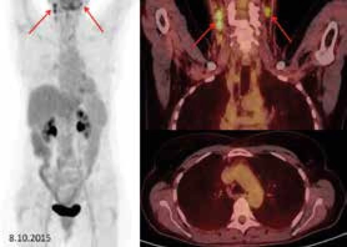 Vlevo sumované obrázky (tzv. MIP), vpravo fúzované FDG-PET/CT koronární řezy (krk) a axiální řezy (mediastinum).