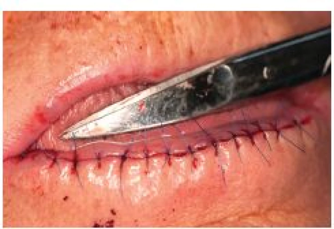 Sutura rány po celkové excizi retní červeně („lip shaving“) dolního rtu