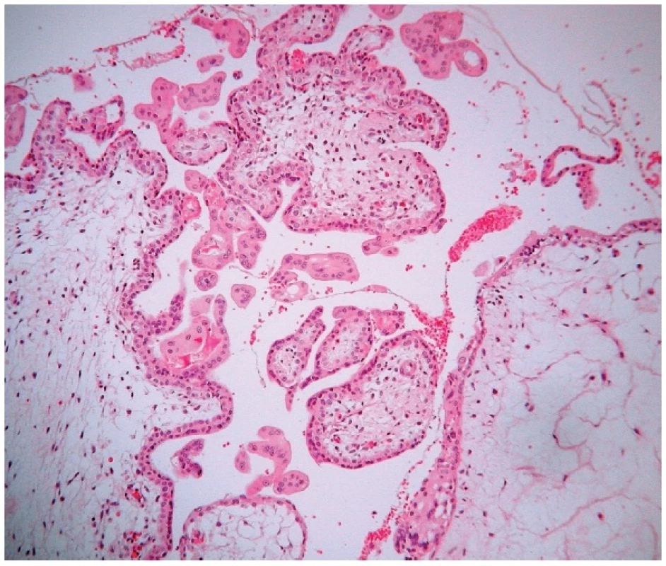 Parciálna hydatidózna mola. Prítomné avaskulárne, edematózne zmenené klky s fokálnou proliferáciou buniek trofoblastu na povrchu klkov. Farbené hematoxylínom eozínom (zväčšenie 200x).