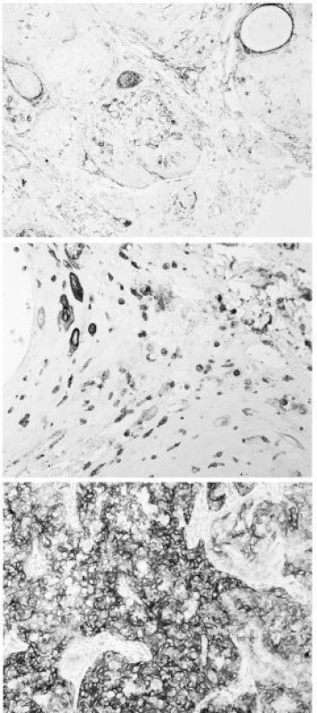 Cytoplasmic immunoexpression of CD10 as seen in different cases of squamous cell carcinoma (SCC): keratoacanthomatous (KA)-type (top); non-KA, well differentiated SCC (middle); and moderately differentiated SCC (bottom)