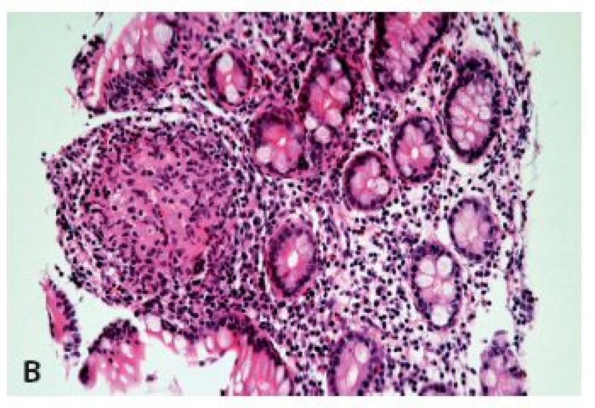 Postižení jícnu Crohnovou chorobou. V biopsii je zastižena pouze mírná ložisková lymfocytární infiltrace dlaždicového epitelu a subepiteliálního stromatu s ojedinělými neutrofily je zcela nepříznačná (A) (HE, 400x), v biopsii z distálního ilea však byly zastiženy charakteristické změny i s epiteloidními granulomy (B) (HE, 400x).