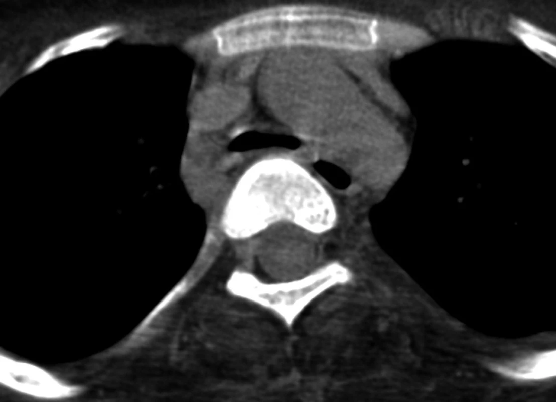 Nativně provedené CT hrudníku, snímky v referenční úrovni oblouku aorty – vstupní vyšetření v červnu 2007