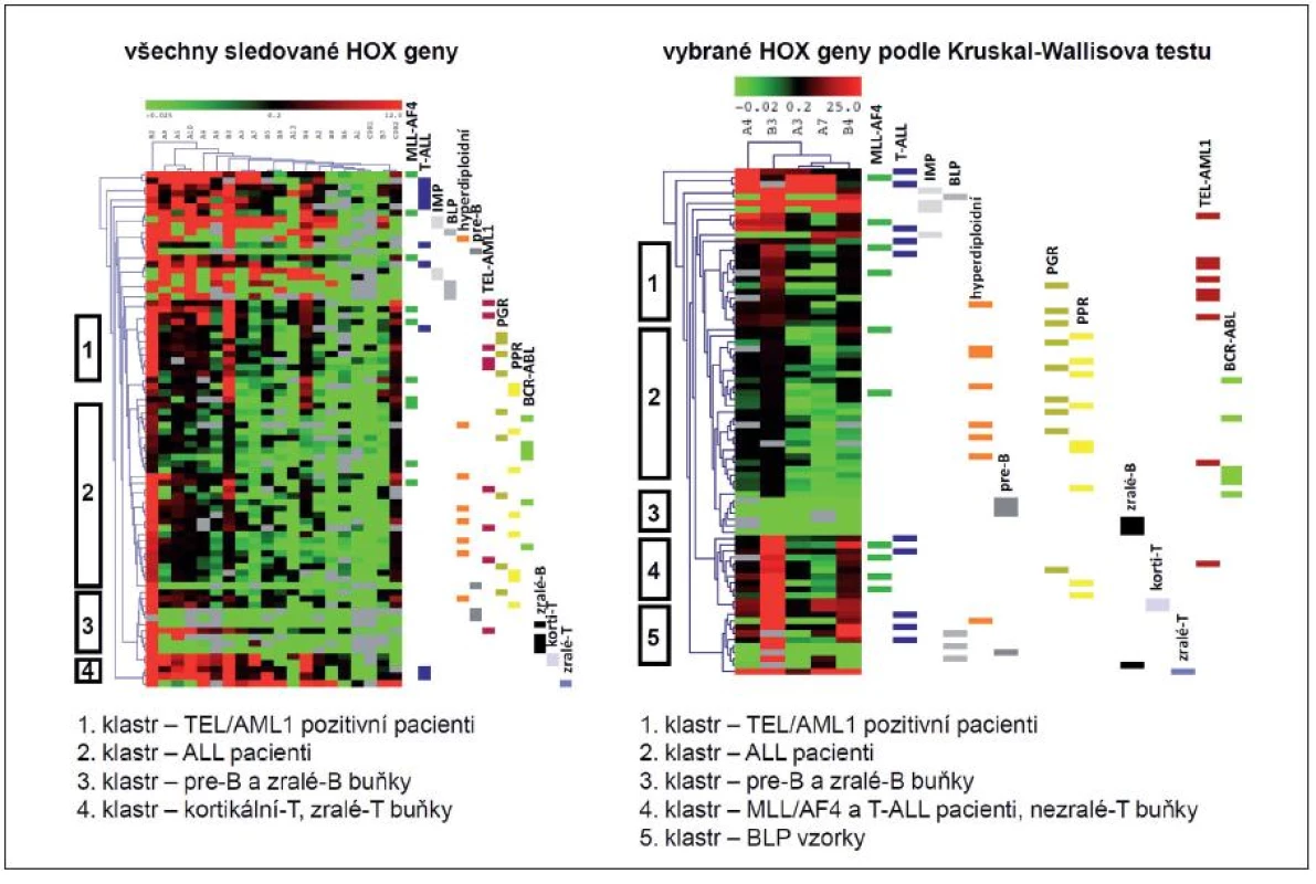 Hierarchická klastrovací analýza leukemických buněk pacientů s ALL a jejich fyziologických protějšků na základě exprese HOX genů. Sledováním exprese všech studovaných HOX genů (a) a HOX genů signifikantně rozdílných na základě analýzy Kruskalovým-Wallisovým testem (b) jsme provedli HCL u vzorků dětských ALL pacientů rozdělených podle fenotypu, genotypu a prognózy. Tyto vzorky jsme dále srovnávali s normálními fyziologickými protějšky B a T buněk. HCL podle míry shody exprese jednotlivých genů shlukuje vyšetřované vzorky do skupin (klastrů).