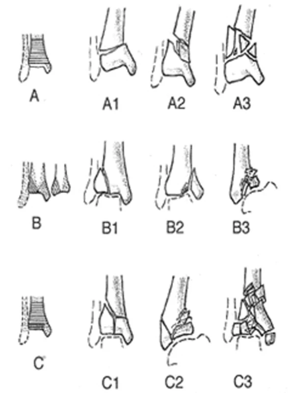 Klasifikace zlomenin dle AO
Fig. 1: Classification of fractures according to AO