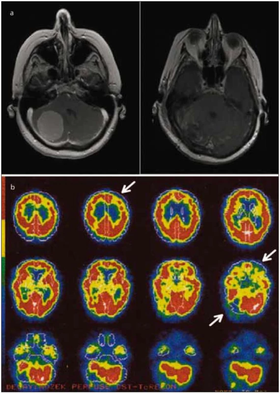 Zobrazení mozku pacientky pomocí MR a SPECT.
Obr. 1a) Léze způsobená nádorem (meningeom) v pravé mozečkové hemisféře, sekvence T1 s kontrastem před (vlevo) a po operaci.
Obr. 1b) Výpadek perfuze v zobrazení SPECT v mozečku a ve frontální oblasti kontralaterální k lézi mozečku (označeny šipkami). Vyšetření bylo provedeno po odstranění nádoru, stejně jako neuropsychologické vyšetření. Data jsou zobrazena v pseudobarvách udávajících míru relativní perfuze vyznačenou na škále vlevo.
Deficit kognice u pacientů s lézí mozečku lze vysvětlit funkčním napojením mozečku na kontralaterální frontální lalok, což se označuje jako zkřížená cerebro-cerebellární diaschíza.