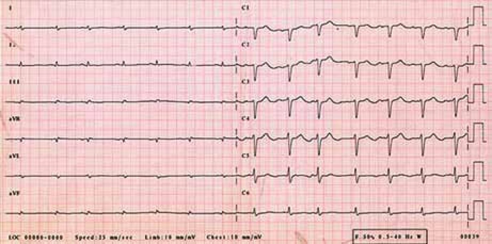 EKG – sinusový rytmus, výrazně nízká voltáž v končetinových svodech, obraz „pseudoinfarktu“ přední stěny (QS V&lt;sub&gt;1–3&lt;/sub&gt;).