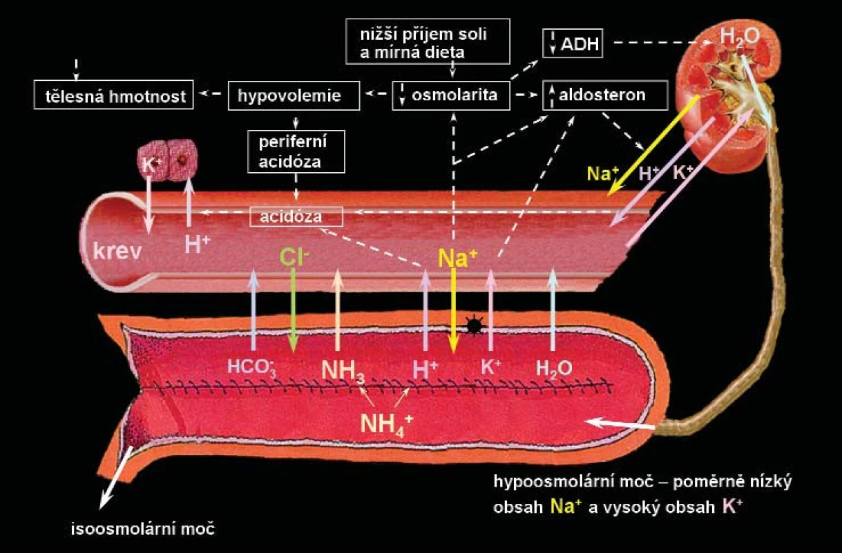Mechanismus vzniku hyperchloremické acidózy (syndrom úbytku soli) u pacientů s ortotopickou neovezikou z ileálního segmentu. Následkem hypoosmolarické moči, kdy dochází ve střevě díky transportu NaCl do moči k obnově isoosmolárního stavu, se dostává úbytek soli výměnou za Na&lt;sup&gt;+&lt;/sup&gt; a H&lt;sup&gt;+&lt;/sup&gt; z moči do krevního řečiště.
Otištěno se svolením.
ADH – antidiuretický hormon, H&lt;sub&gt;2&lt;/sub&gt;0 – voda, Na&lt;sup&gt;+&lt;/sup&gt;– sodík, H&lt;sup&gt;+&lt;/sup&gt;– vodík, K&lt;sup&gt;+&lt;/sup&gt;– draslík, Cl&lt;sup&gt;-&lt;/sup&gt; – chlor, HCO&lt;sub&gt;3&lt;/sub&gt;&lt;sup&gt;-&lt;/sup&gt; – hydrogenuhličitan sodný, NH3&lt;sup&gt;-&lt;/sup&gt; amoniak, NH4&lt;sup&gt;+&lt;/sup&gt;– amonium [34].