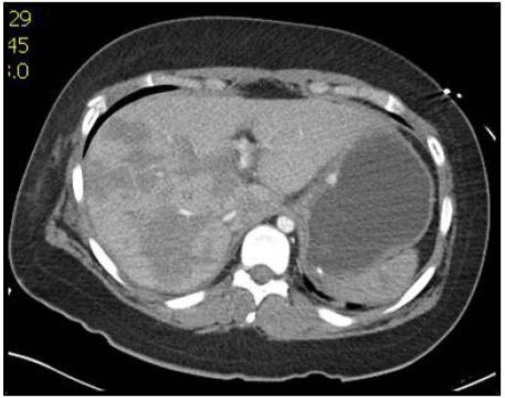 Angio CT snímky jater: Poranění jater IV. stupně s nálezem krvácení z poranění arteria hepatica propria
