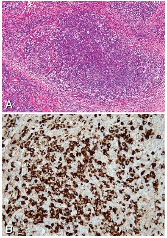 Chronická sklerózující sialoadenitida
A. Intenzivní lymfoplazmocelulární zánětlivý infiltrát ve tkáni submandibulární žlázy s těžkou atrofií sekreční komponenty (acinů a tubulů) jsou patrna pouze rezidua intralobulárních vývodů a fibróza ve formě vazivových pruhů (HE, zvětšeno 100×) 
B. Pozitivní imunohistochemický průkaz IgG4 ve formě hnědého zabarvení
cytoplazmy plazmatických buněk (zvětšeno 400×)