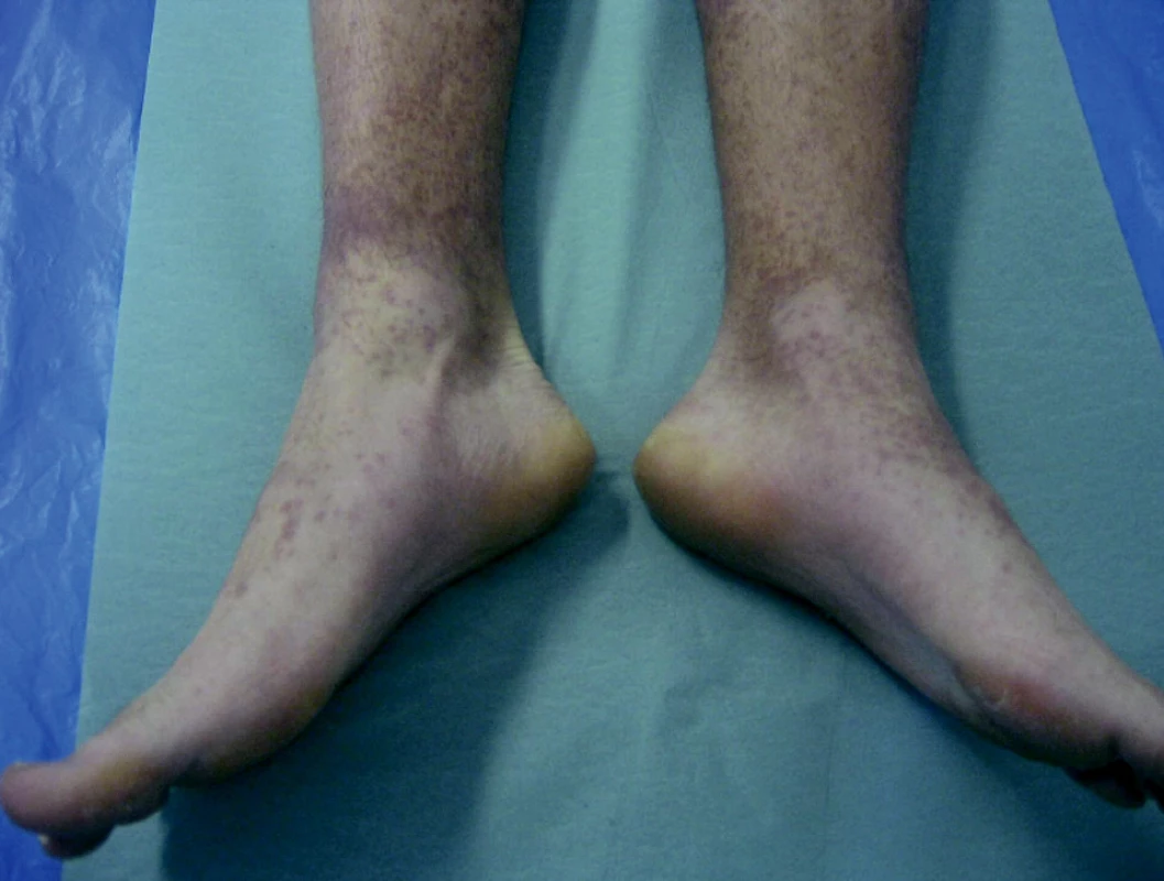 Gloves and socks syndrome, 17-ročný chlapec (parvovírus B19)