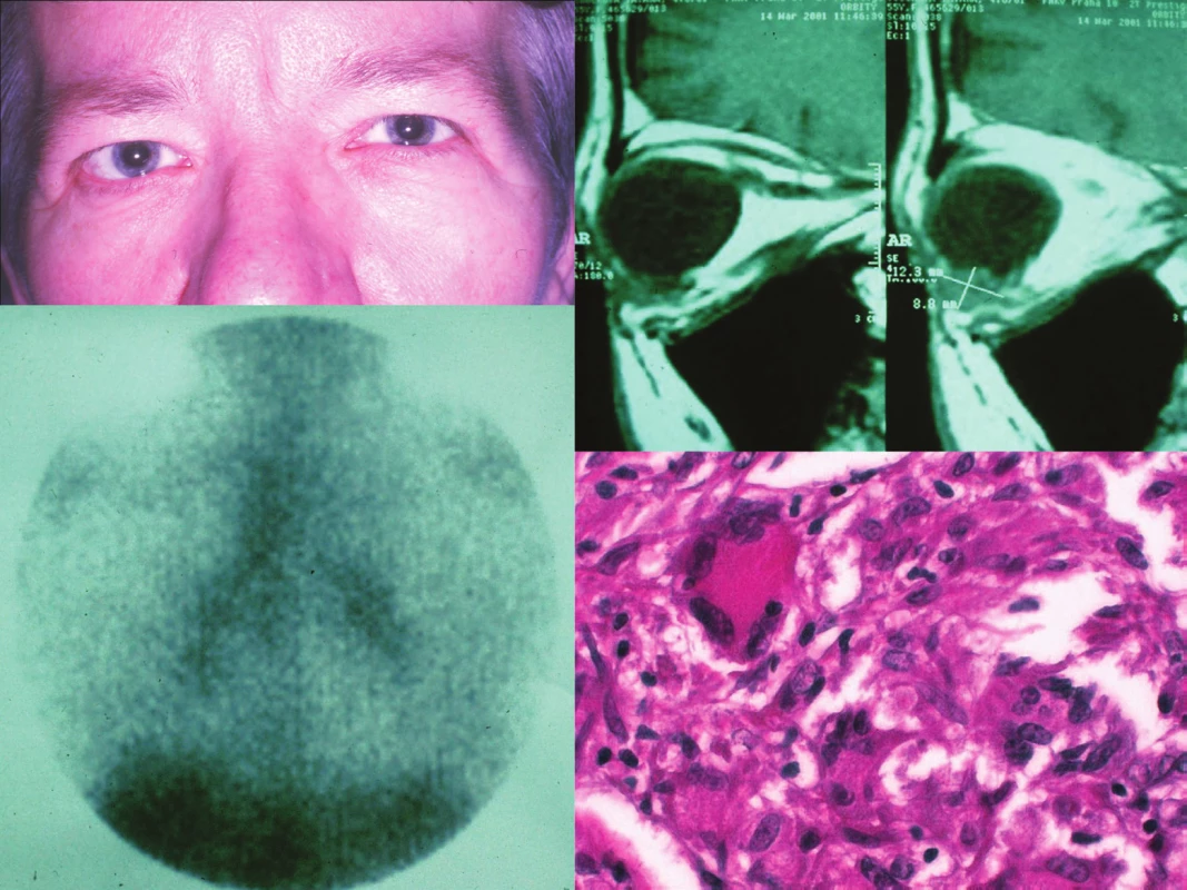 Klinický obraz orbitálního postižení vpravo (a), nález orbitálního tumoru na MR (b), obraz galliového scanu (c) a histologická verifikace orbitální biopsie (d) u pacientky s orbitálním zánětlivým syndromem a intrathorakálním projevem sarkoidózy