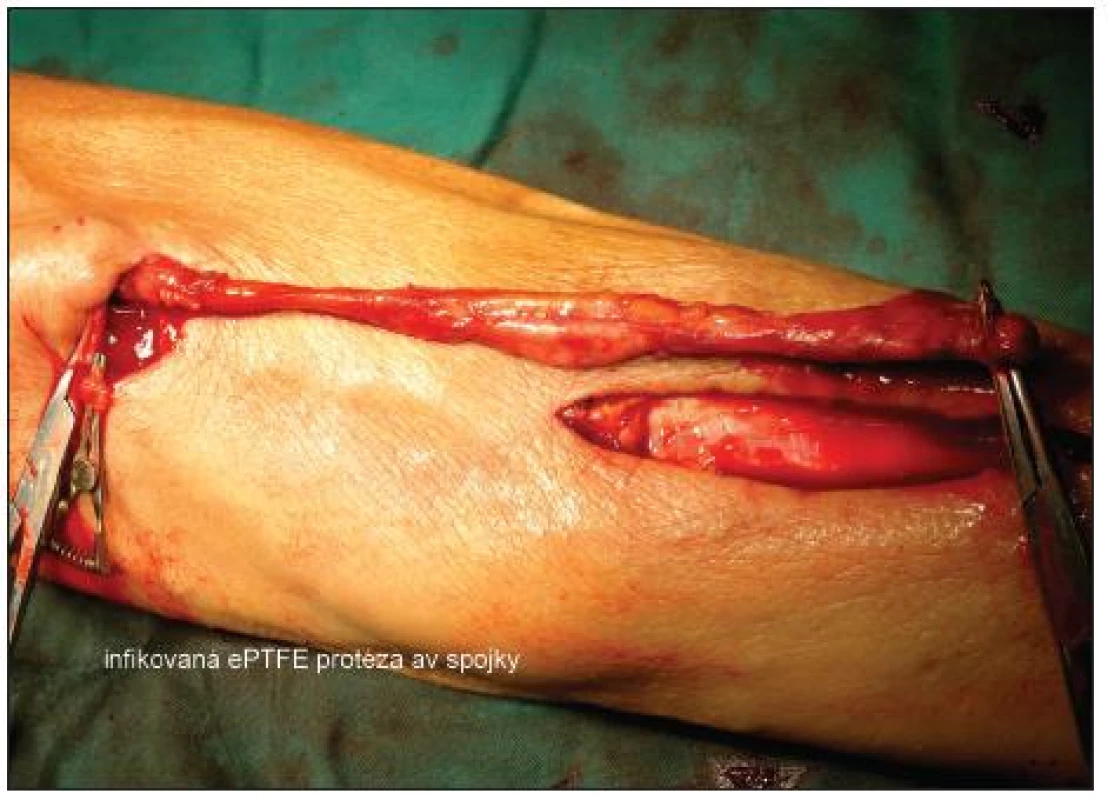 Infikovaná ePTFE protéza av spojky
Fig. 2. Infected ePTFE A-V shunt prosthesis
