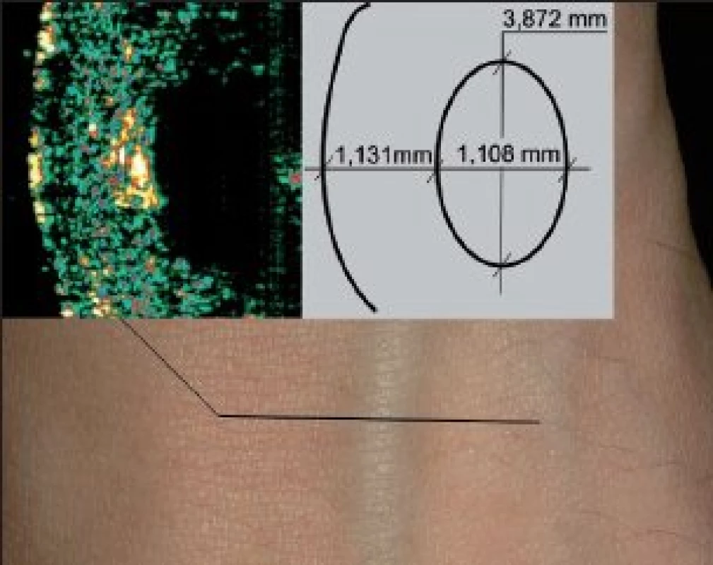 Příklad zjištění hloubek a rozměrů pomocí ultrazvuku