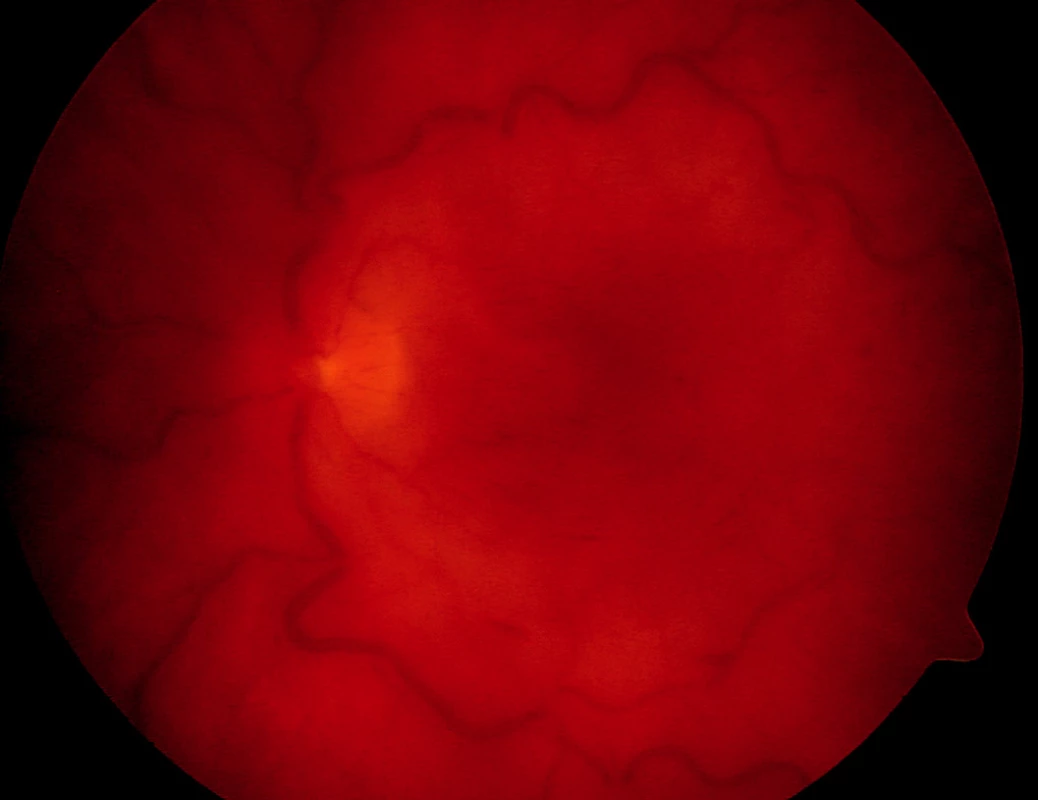 Leukémie s obrazem okluze centrální retinální žíly levého oka u 57leté pacientky
