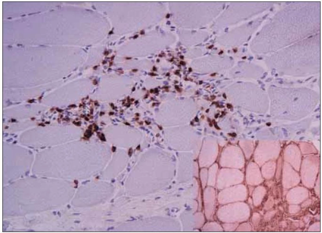 Imunohistochemický průkaz antigenu CD8 T lymfocytů zánětlivého infiltrátu.
Imunoperoxidázová metoda, zvětšení 200×. Výřez: Difuzní pozitivita povrchu svalových vláken v imunohistochemickém průkazu antigenu HLA-I. Imunoperoxidázová metoda, zvětšení 200×.