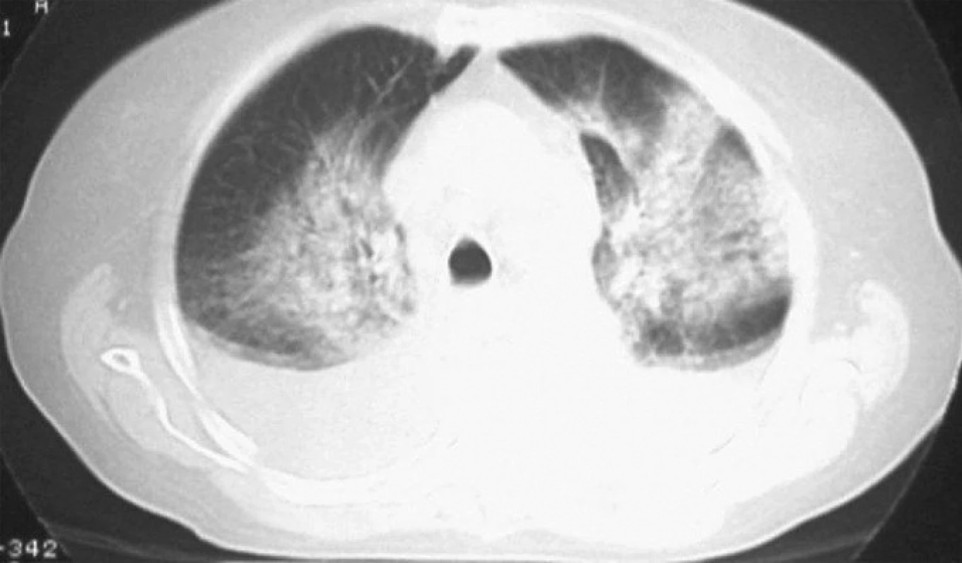 CT hrudníku – oboustranné infiltráty s maximem v horních plicních polích a oboustranný fluidothorax.