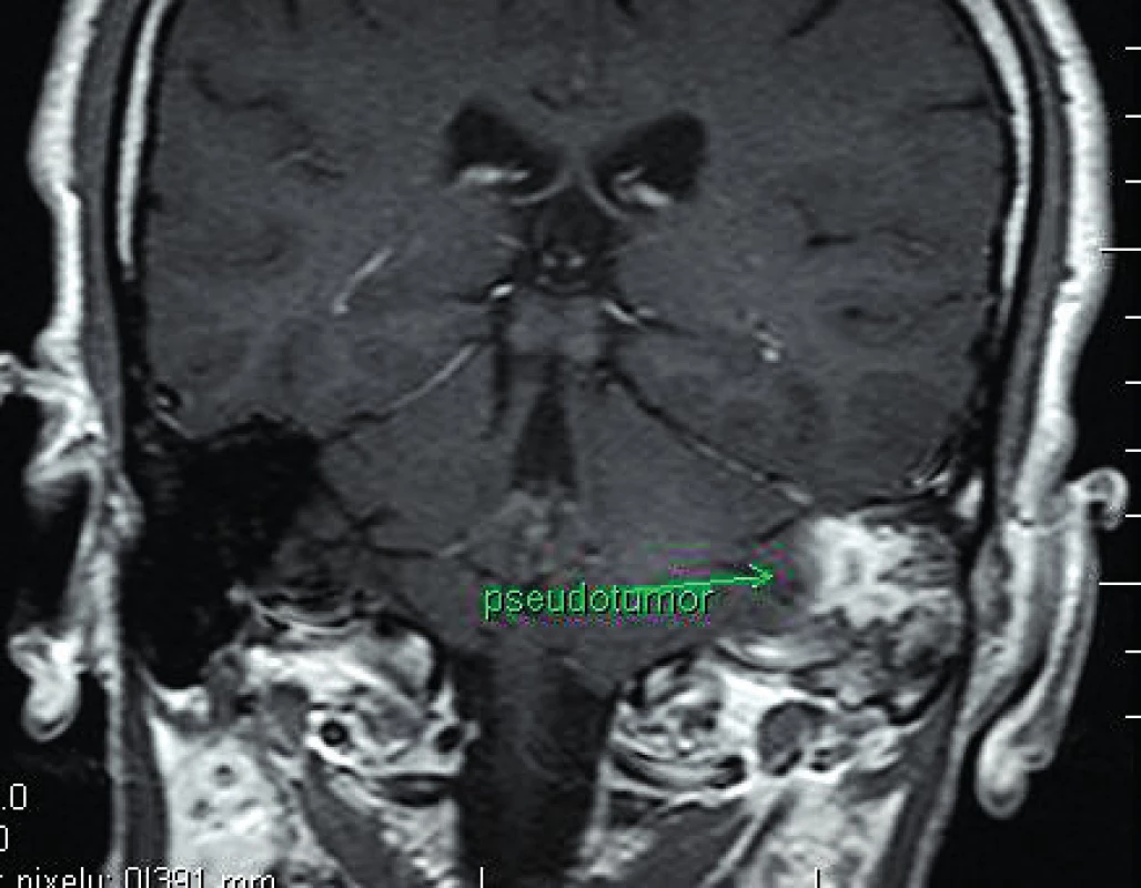 MRI koronární zobrazení pseudotumoru levé pyramidy (T1 sken).